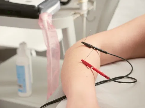 Electro Acupuncture Tennis Elbow